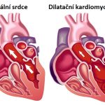 Dilatační kardiomyopatie – co je to – příznaky, příčiny a léčba