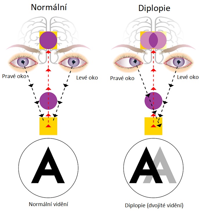 Diplopie (dvojité vidění) - ilustrace
