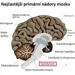 Ependymom – co je to – příznaky, příčiny a léčba