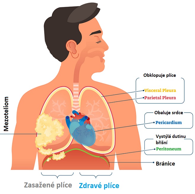 Mezoteliom - ilustrace