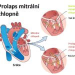 Prolaps mitrální chlopně – co je to – příznaky, příčiny a léčba