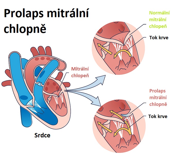 Prolaps mitrální chlopně - ilustrace