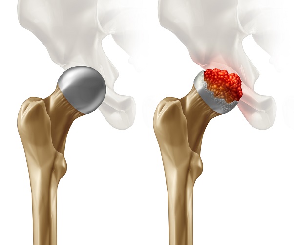 Pokud se osteonekróza vyskytne v oblasti kloubu, může to mít značné dopady na jeho funkci a pohyblivost.