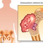 Osteosarkom – co je to – příznaky, příčiny a léčba