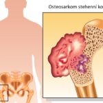 Osteosarkom – co je to – příznaky, příčiny a léčba