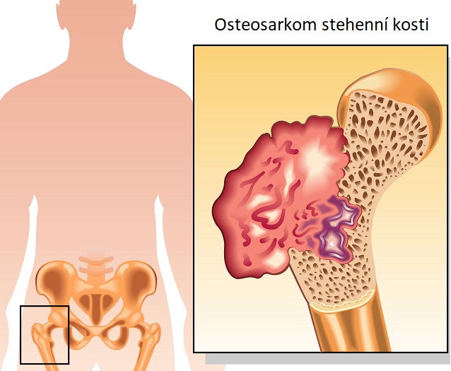 Osteosarkom stehenní kosti - ilustrace