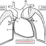 Pneumomediastinum – co je to – příznaky, příčiny a léčba