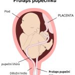 Prolaps (výhřez) pupečníku – co to je, jaké má příznaky a jak se řeší?