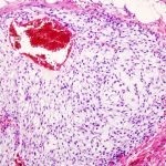 Chondrosarkom (nádor chrupavky) – co je to – příznaky, příčiny a léčba