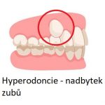 Hyperodoncie (hyperdoncie) – nadbytek zubů – příznaky, příčiny a léčba