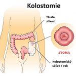 Kolostomie – umělý vývod z tlustého střeva – kdy, jak a proč se dělá?