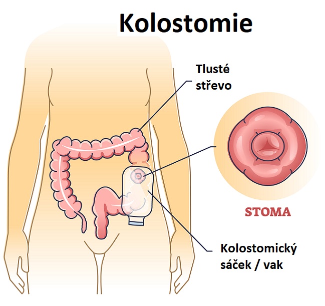 Kolostomie - ilustrace