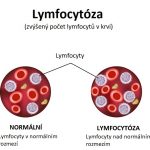 Lymfocytóza – zvýšený počet lymfocytů – příznak, příčiny a léčba