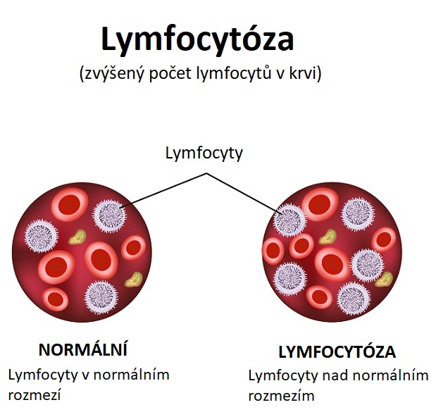 Lymfocytóza - ilustrace