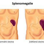 Splenomegalie – zvětšená slezina – příznaky, příčiny a léčba