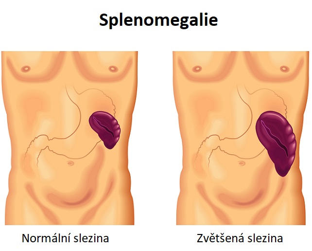 Splenomegalie - zvětšená slezina - ilustrace