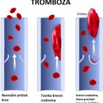 Tromboembolie – co je to – příznaky, příčiny a léčba