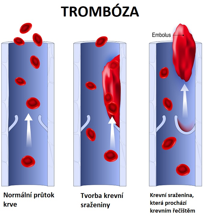 Tromboembolismus - ilustrace