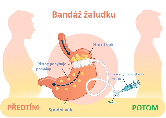 Bandáž žaludku - ilustrace