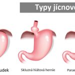 Jícnová kýla (hiátová hernie) – příznaky, příčiny a léčba