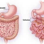 Malrotace střeva – porucha rotace střeva – příznaky, příčiny a léčba