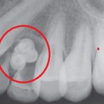 Odontom – nezhoubný nádor dentální tkáně – příznaky, příčiny a léčba