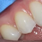 Jak se dají posílit dásně?