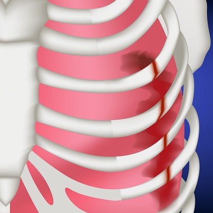 Zlomené žebro může poškodit i plíci, ale zlomenina musí být vážnější