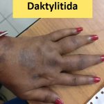 Daktylitida – zánět a otok prstů – příznaky, příčiny a léčba