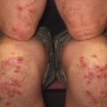 Duhringova choroba (Dermatitis Herpetiformis) – důsledek citlivosti na lepek – jak se léčí?