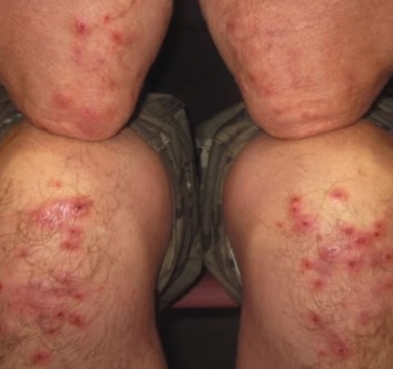 Dermatitis herpetiformis