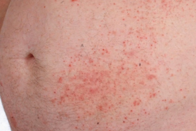 Dermatitis herpetiformis na břiše