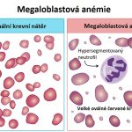 Megaloblastová anémie – porucha tvorby červených krvinek v kostní dřeni – příznaky, příčiny a léčba