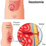 Ileostomie – umělý výstup z tenkého střeva – kdy a jak se provádí?