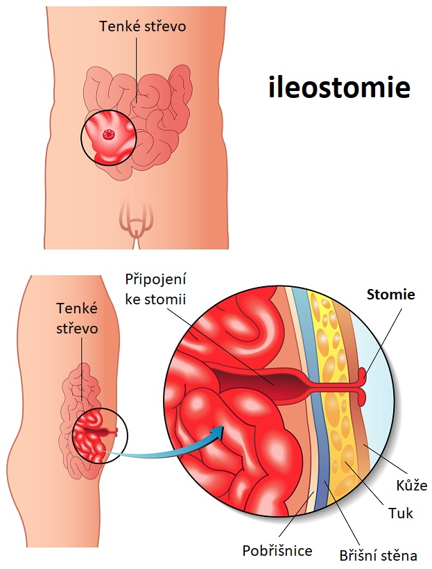 Ileostomie - ilustrace