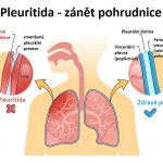 Pleuritida – zánět pohrudnice – příznaky, příčiny a léčba