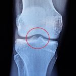 Osteom – nezhoubný kostní nádor – příznaky, příčiny a léčba