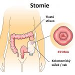 Stomie – chirurgicky vytvořený otvor na těle – péče, komplikace a typy stomie