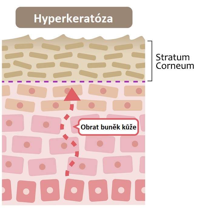 Hyperkeratóza - ilustrace
