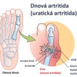 Dnová artritida (uratická artritida) – příznaky, příčiny a léčba