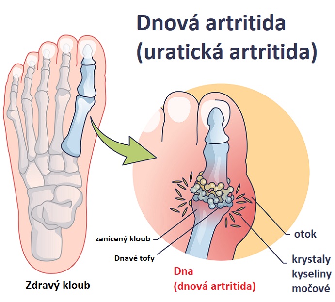 Dnovou artritidou bývá postižen nejčastěji kloub palce u nohy