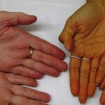 Karotenémie – nadměrné množství beta-karotenu v těle – příznaky, příčiny a léčba