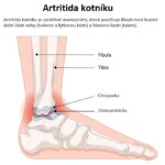Artritida kotníku – příznaky, příčiny a léčba