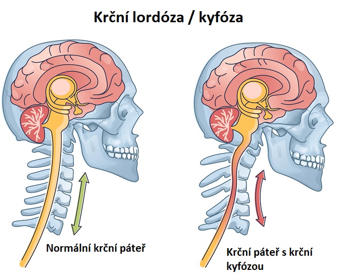 Lordóza a kyfóza v oblasti krční páteře