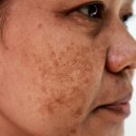 Melasma (chloasma) – chronické pigmentové onemocnění kůže – příznaky, příčiny a léčba