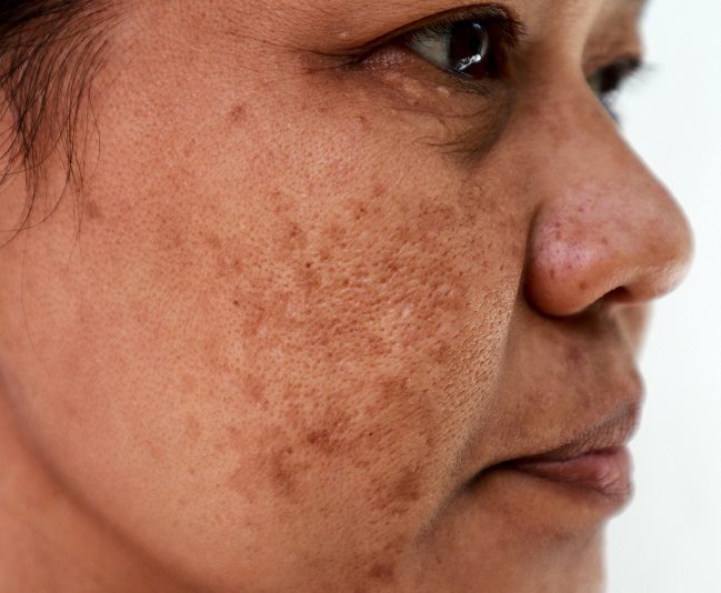Takto může vypadat melasma v obličeji
