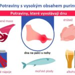 Hyperurikémie – zvýšená hladina kyseliny močové v krvi – příznaky, příčiny a léčba