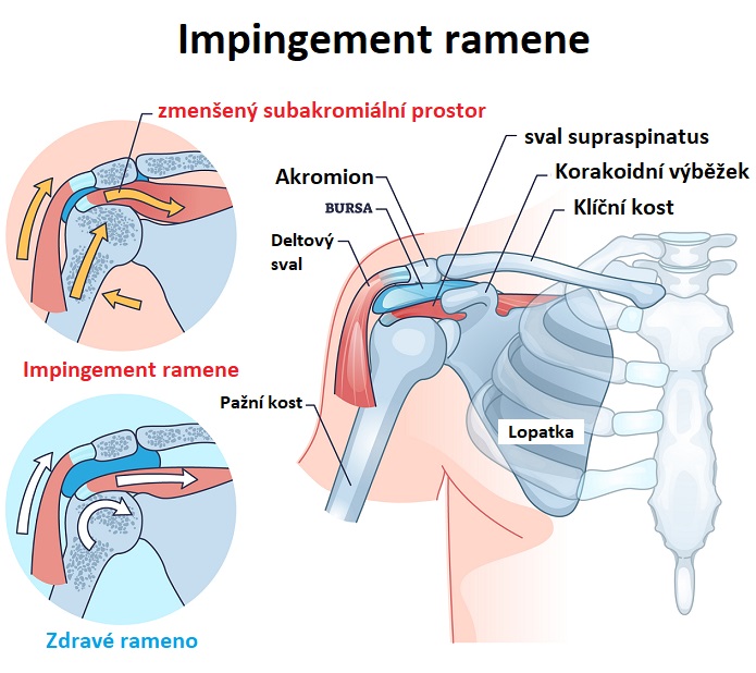 Impingement ramene - ilustrace