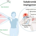 Subakromiální impingement (syndrom bolestivého ramene) – příznaky, příčiny a léčba