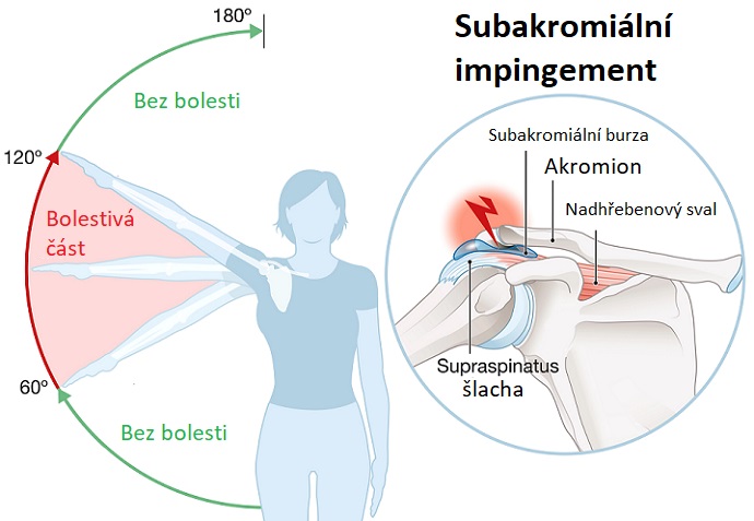 Subakromiální impingement - ilustrace